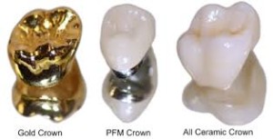 dental crown