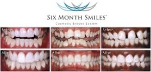 orthodontic dental braces